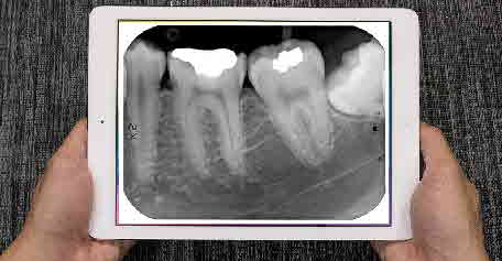 Apple-iPad-X-Ray